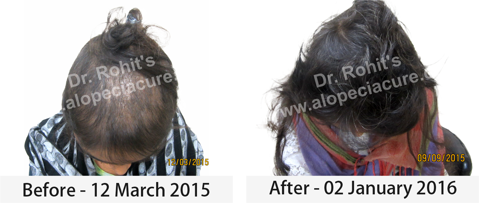 hair loss treatment